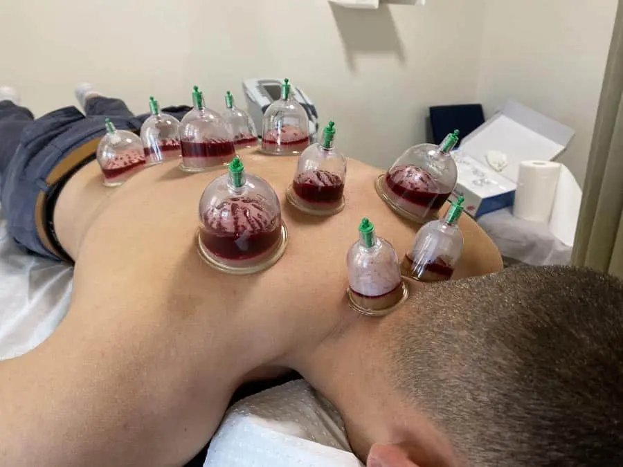 Hijama cupping therapy session